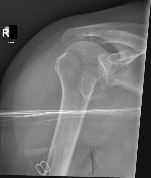 File:Bilateral posterior shoulder dislocation (Radiopaedia 54102-60520 Frontal 1).jpg