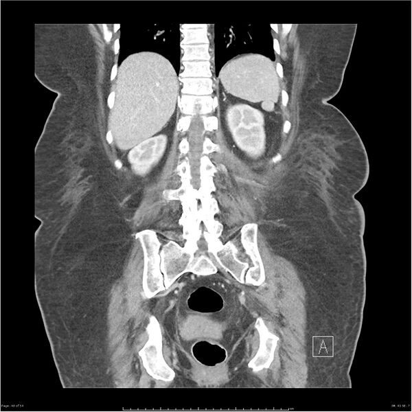 File:Bilateral psoas hematomas (Radiopaedia 24057-24279 B 40).jpg