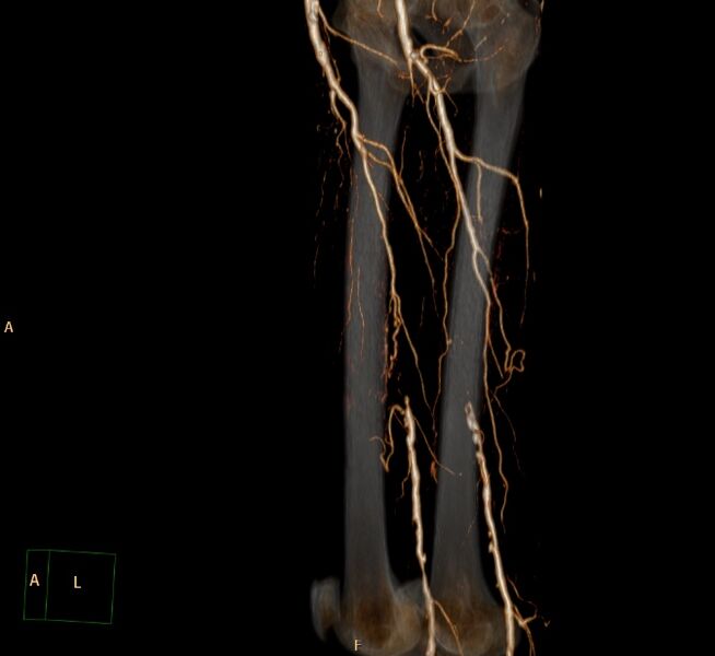File:Bilateral superficial femoral arterial occlusion (Radiopaedia 25682-25857 3D VR 17).jpg