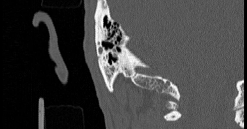 Bilateral temporal bone fractures (Radiopaedia 29482-29970 Coronal non-contrast 165).jpg