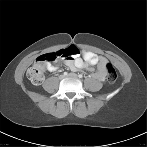 File:Bilateral ureteritis and cystitis (Radiopaedia 25340-25594 A 47).jpg