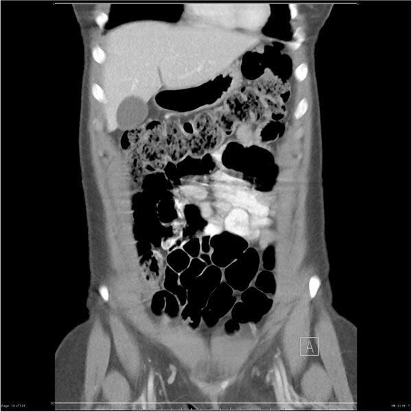 File:Bilateral ureteritis and cystitis (Radiopaedia 25340-25594 B 10).jpg