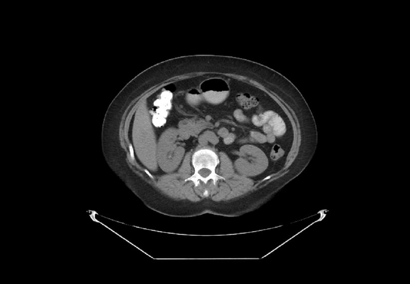 File:Bilateral urolithiasis with incidentally detected splenic artery aneurysm and left inferior vena cava (Radiopaedia 44467-48123 Axial non-contrast 22).jpg