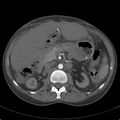 Biliary necrosis - liver transplant (Radiopaedia 21876-21846 A 30).jpg