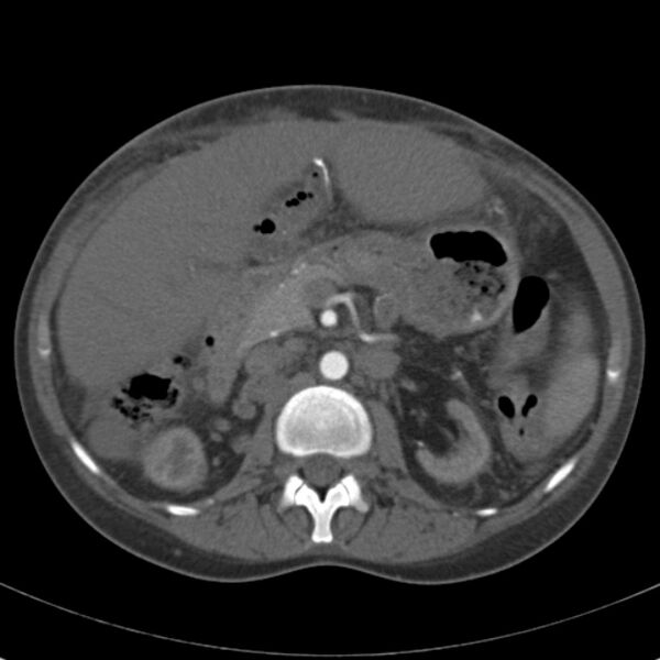 File:Biliary necrosis - liver transplant (Radiopaedia 21876-21846 A 30).jpg