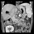 Biliary necrosis - liver transplant (Radiopaedia 21876-21846 C 25).jpg