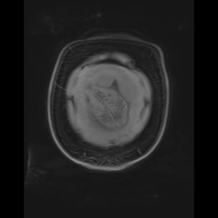 Bilobed placenta accreta (Radiopaedia 69648-79591 Coronal T1 vibe 18).jpg