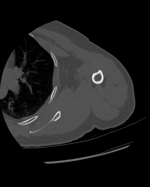 File:Bizarre parosteal osteochondromatous proliferation (Radiopaedia 84221-99501 Axial bone window 30).jpg