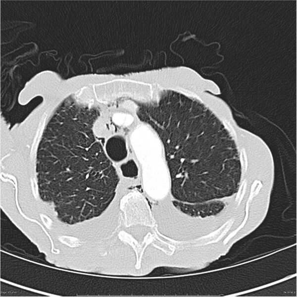 File:Boerhaave syndrome (Radiopaedia 26240-26362 Axial lung window 13).jpg
