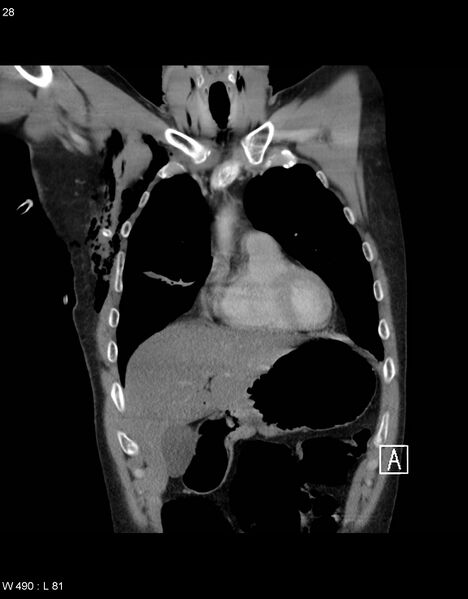 File:Boerhaave syndrome with tension pneumothorax (Radiopaedia 56794-63605 B 9).jpg