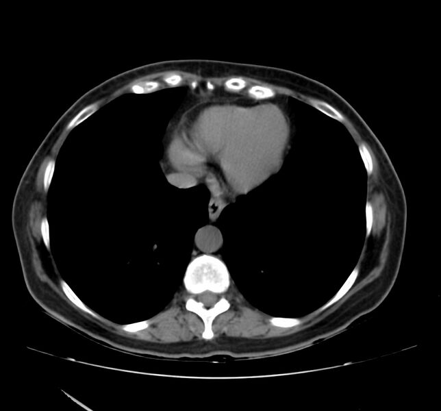 File:Bosniak renal cyst - type IV (Radiopaedia 22929-22953 Axial non-contrast 1).jpg