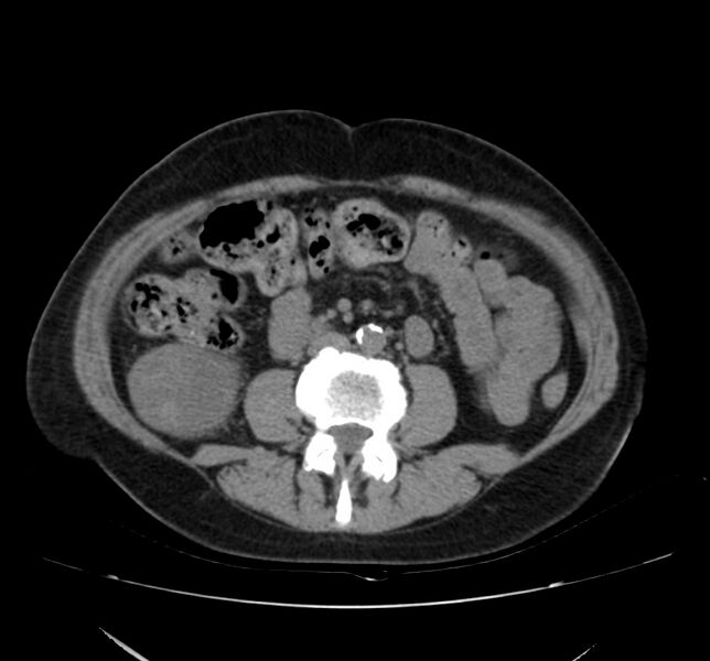 File:Bosniak renal cyst - type IV (Radiopaedia 22929-22953 Axial non-contrast 32).jpg