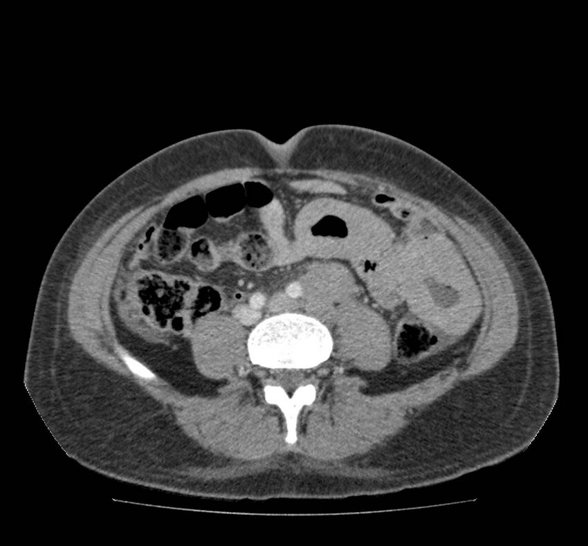 Bowel lymphoma complicated by bleeding after therapy (Radiopaedia 55601-62107 A 52).jpg