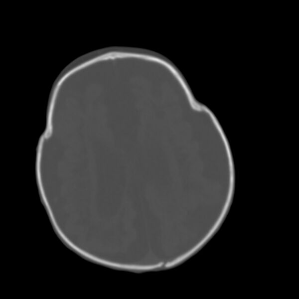 File:Brachycephaly (bi-coronal and bi-lambdoid synostosis) (Radiopaedia 55048-61413 Axial bone window 15).jpg