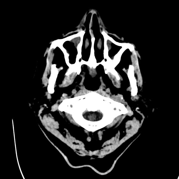 File:Brain Pantopaque remnants (Radiopaedia 78403-91048 Axial non-contrast 8).jpg