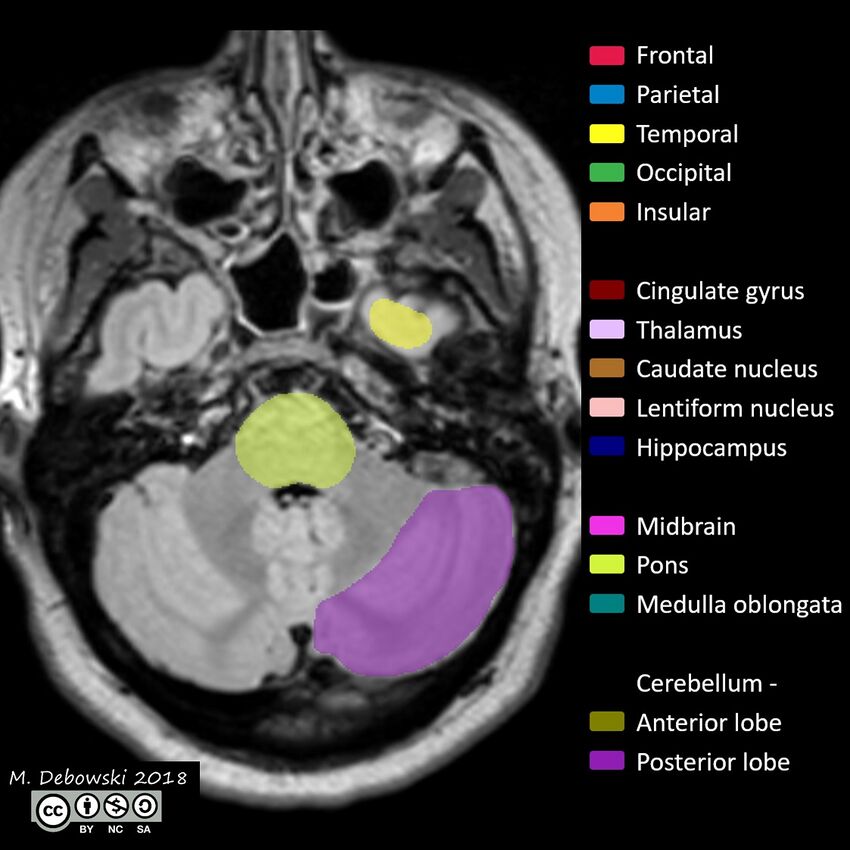 Brain lobes - annotated MRI (Radiopaedia 61691-69700 Axial 61).JPG