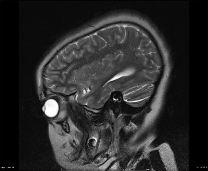 File:Brainstem glioma (Radiopaedia 21819-21775 Sagittal T2 23).jpg