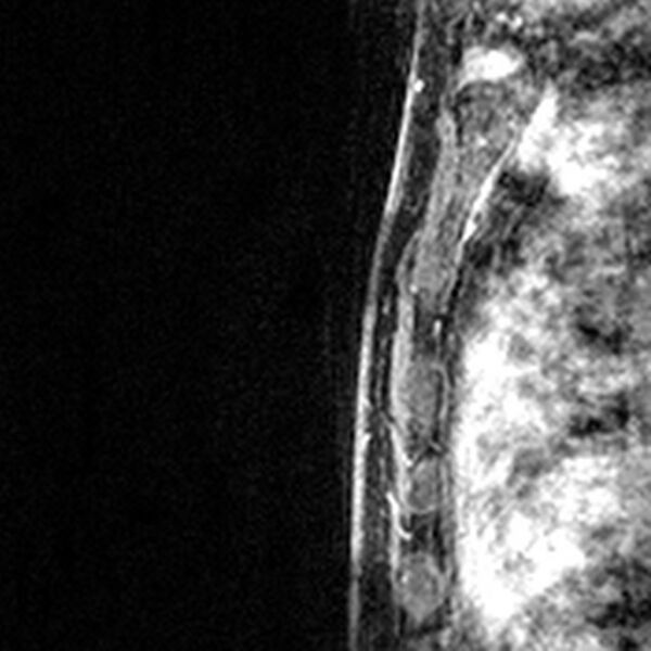 File:Breast implants - MRI (Radiopaedia 26864-27035 Sagittal T2 58).jpg