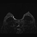 Breast implants - MRI (Radiopaedia 26864-27035 T2 SPAIR 34).jpg