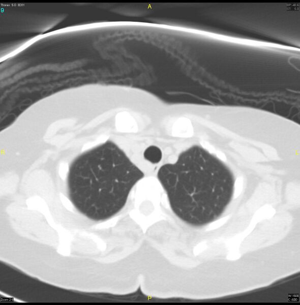 File:Breast primary with lung and bone metastases (Radiopaedia 40620-43228 Axial lung window 9).jpg