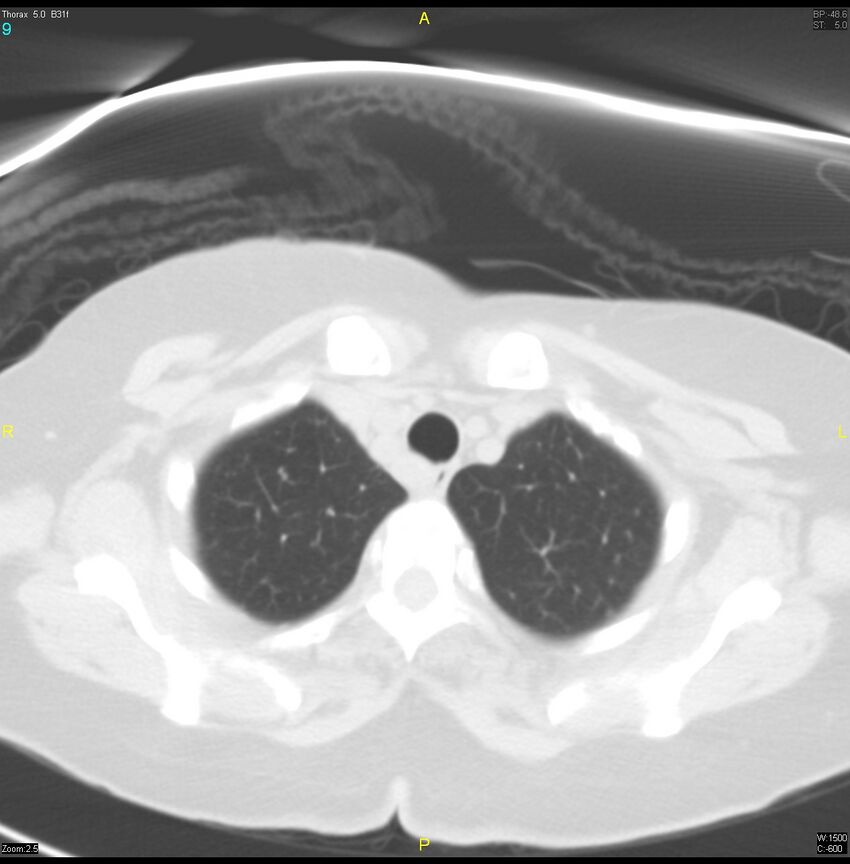 Breast primary with lung and bone metastases (Radiopaedia 40620-43228 Axial lung window 9).jpg