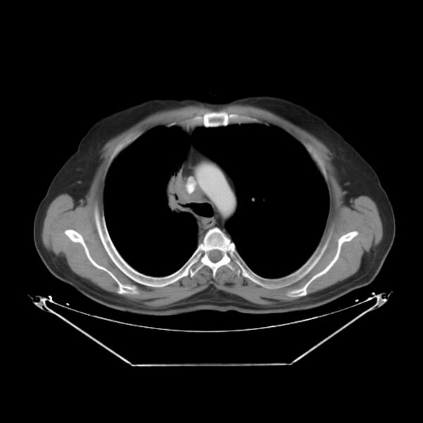 File:Bronchogenic carcinoma with upper lobe collapse (Radiopaedia 29297-29726 C 12).jpg