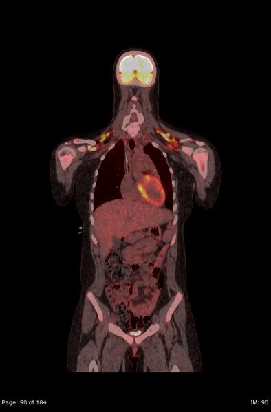 File:Brown fat uptake (FDG PET-CT) (Radiopaedia 77392-89513 Fused coronal 48).jpg