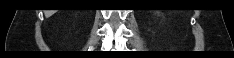 File:Buried bumper syndrome - gastrostomy tube (Radiopaedia 63843-72575 Coronal Inject 77).jpg