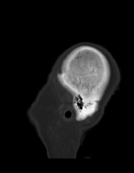 File:Burnt-out meningioma (Radiopaedia 51557-57337 Sagittal bone window 1).jpg