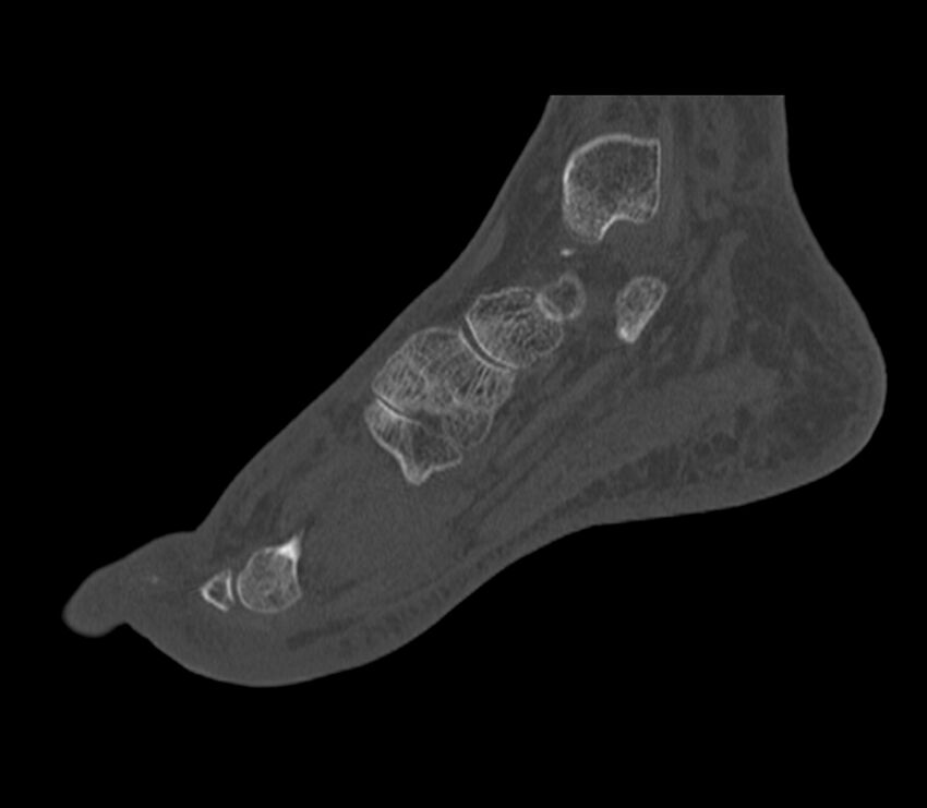 Calcaneal tuberosity avulsion fracture (Radiopaedia 22649-22668 Sagittal bone window 34).jpg
