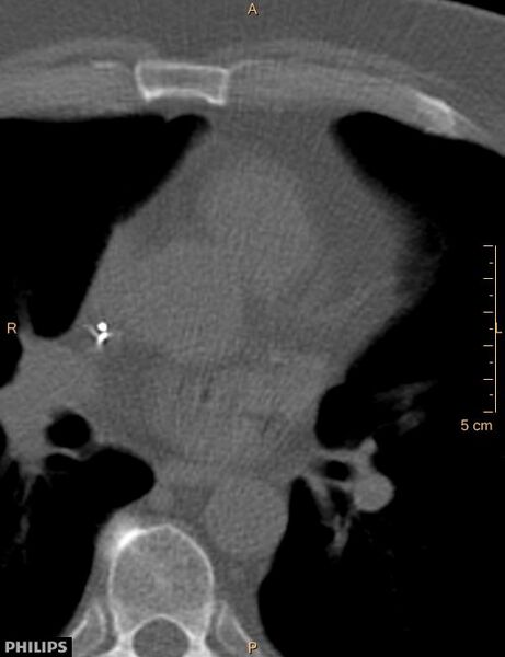 File:Calcified cardiac fibroma (Radiopaedia 39267-41519 Axial bone window 10).jpg