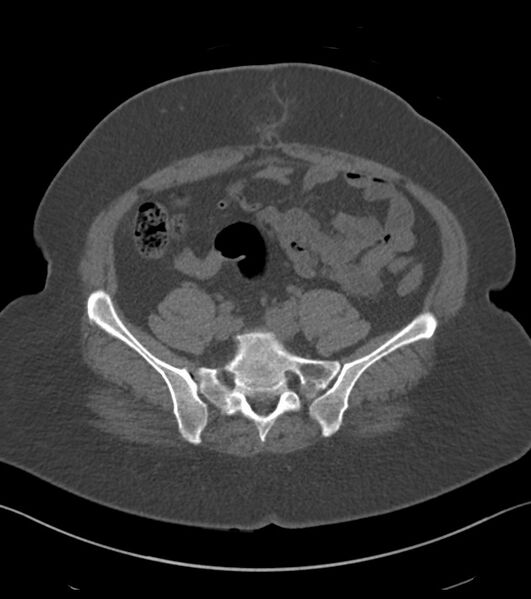 File:Calcified hepatic hydatid cyst (Radiopaedia 81127-94738 Axial non-contrast 73).jpg
