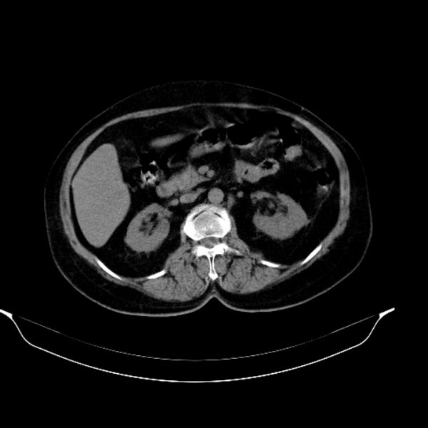 File:Calcified hydatid cyst (Radiopaedia 62000-70085 Axial non-contrast 46).jpg