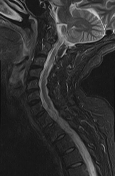 File:Calcified meningioma - cervical canal (Radiopaedia 70136-82468 Sagittal STIR 9).jpg