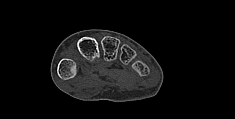 File:Calcifying aponeurotic fibroma (Radiopaedia 88423-105064 Axial bone window 128).jpg