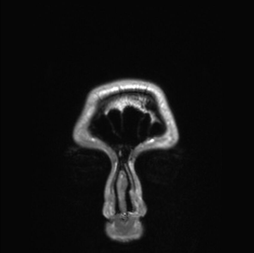 Callosal dysgenesis with interhemispheric cyst (Radiopaedia 53355-59335 Coronal T1 189).jpg