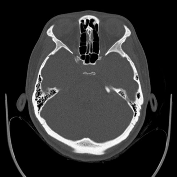 File:Calvarial osteoma (Radiopaedia 36520-38079 Axial bone window 33).jpg