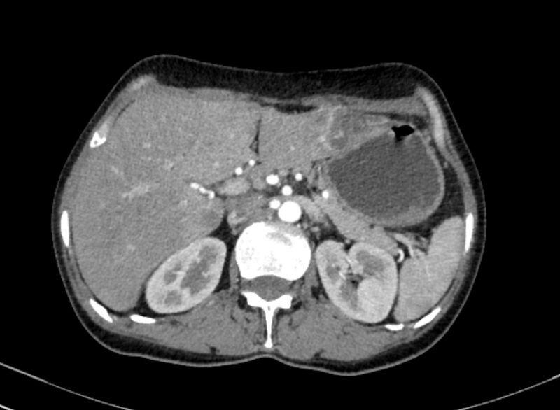 File:Cannonball metastases from breast cancer (Radiopaedia 91024-108569 A 126).jpg