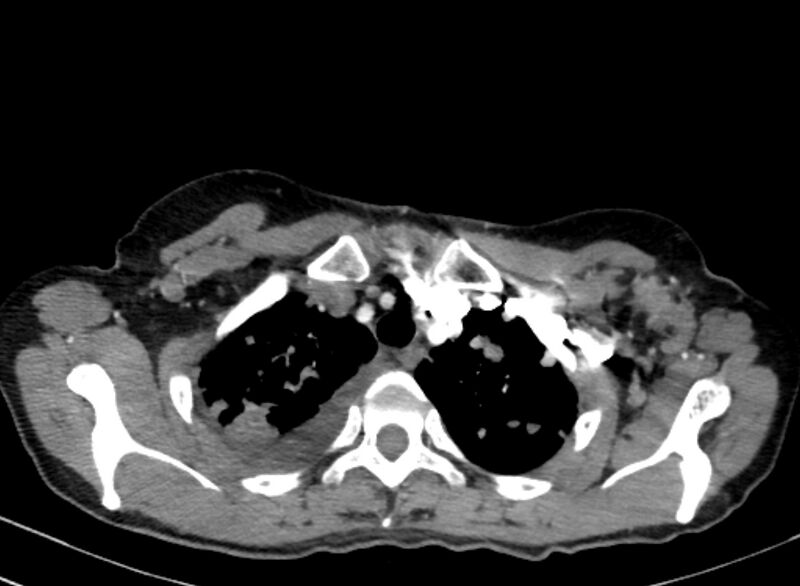 File:Cannonball metastases from breast cancer (Radiopaedia 91024-108569 A 25).jpg