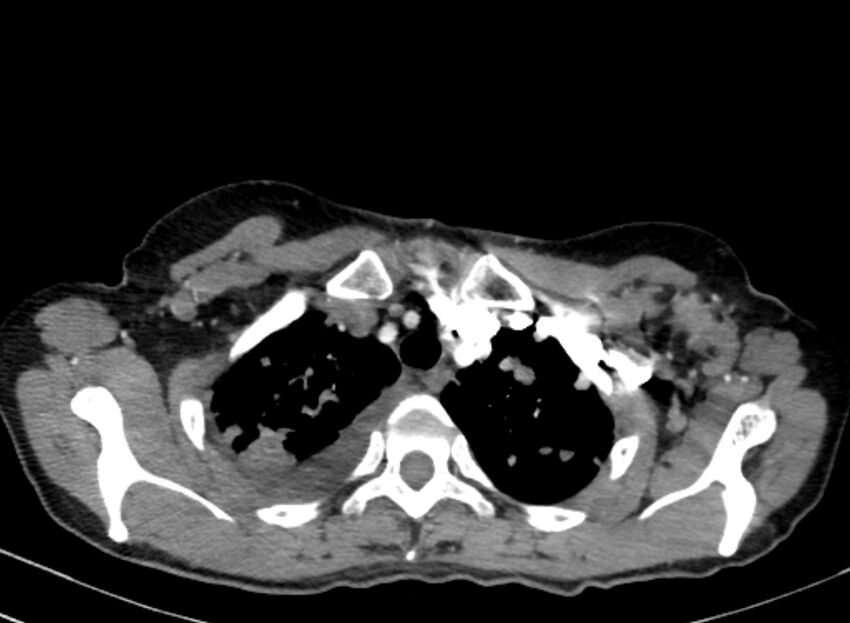 Cannonball metastases from breast cancer (Radiopaedia 91024-108569 A 25).jpg