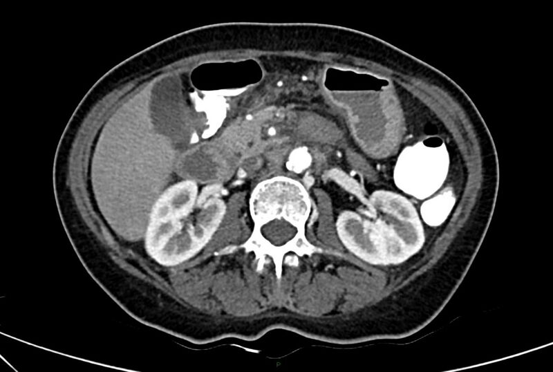 File:Carcinoid mesenteric tumor complicated by chylous ascites (Radiopaedia 76312-88926 A 28).jpg