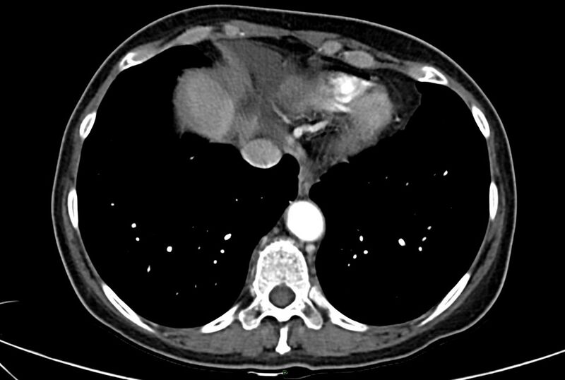 File:Carcinoid mesenteric tumor complicated by chylous ascites (Radiopaedia 76312-88926 A 3).jpg