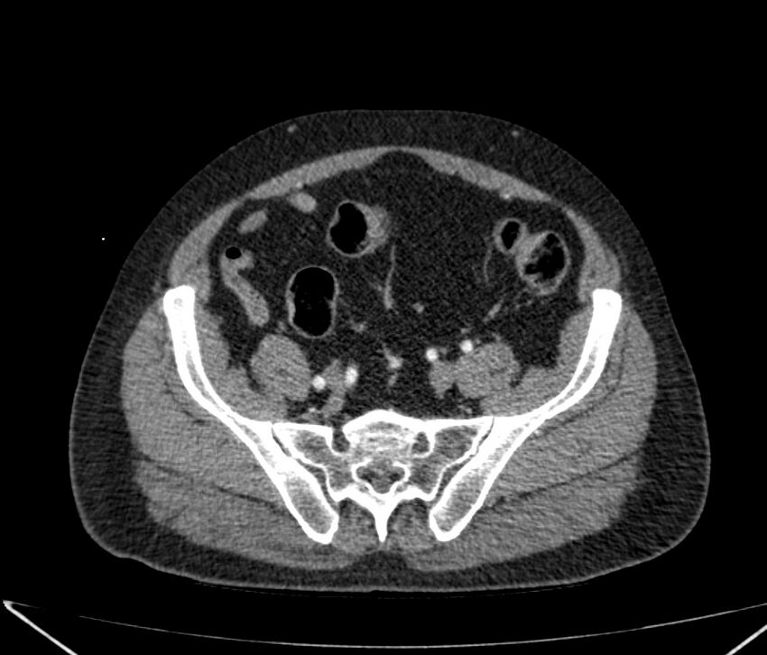 Carcinoid tumor with hepatic metastases (Radiopaedia 22651-22670 B 76).jpg