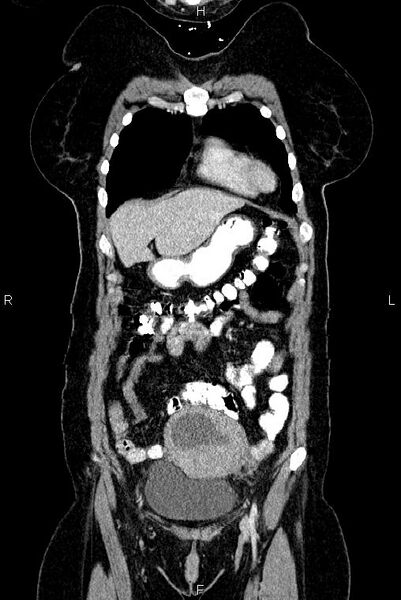File:Carcinoma of uterine cervix (Radiopaedia 85861-101700 C 8).jpg