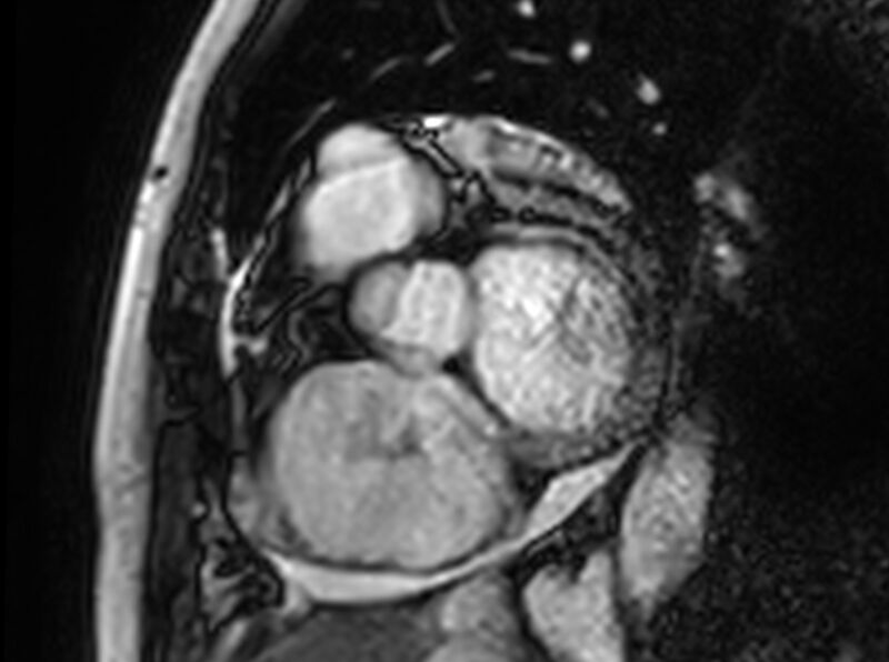File:Cardiac amyloidosis (Radiopaedia 61600-69579 Short axis bSSFP 308).jpg