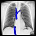 Cardiomediastinal anatomy on chest radiography (annotated images) (Radiopaedia 46331-50742 Frontal 1).png