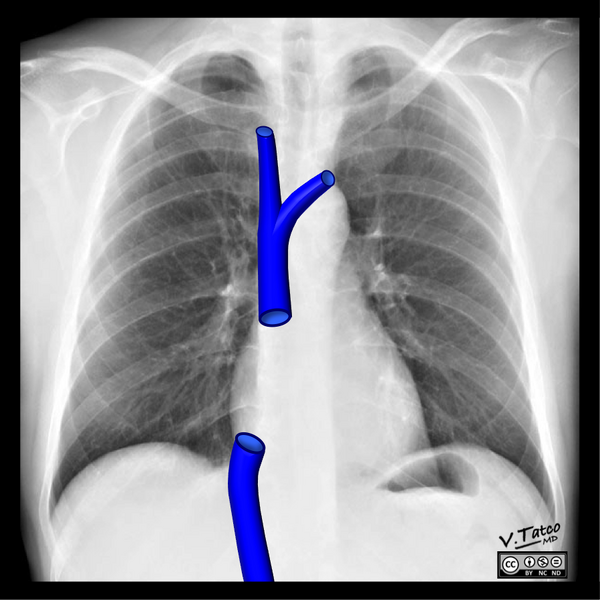 File:Cardiomediastinal anatomy on chest radiography (annotated images) (Radiopaedia 46331-50742 Frontal 1).png
