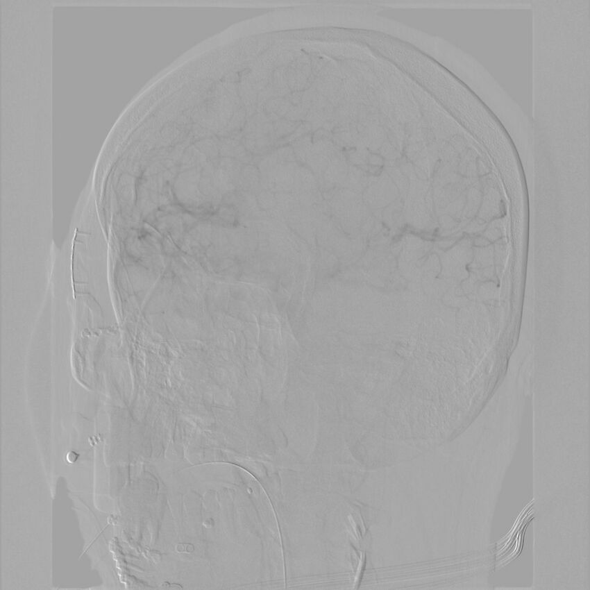 Caroticocavernous fistula - direct (Radiopaedia 61660-69666 Oblique Left ICA 30).jpg
