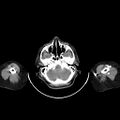 Carotid body tumor (Radiopaedia 21021-20948 A 9).jpg
