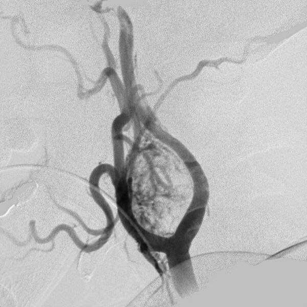 File:Carotid body tumor on angiography (Radiopaedia 4651-6729 A 2).jpg